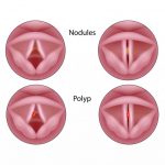 Vocal Nodes – Hội chứng viêm dây thanh đới, triệu chứng và cách phòng tránh!