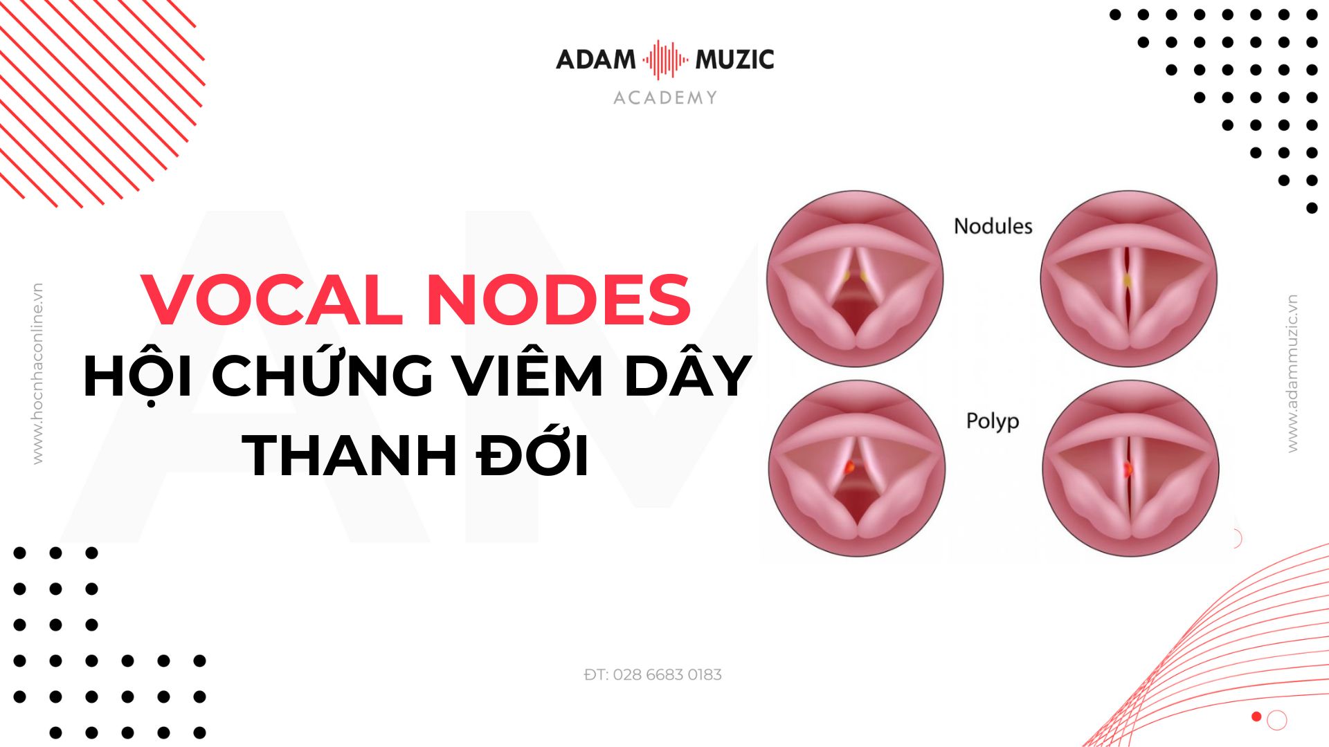 Vocal Nodes - Hội chứng viêm dây thanh quản - Adam Muzic